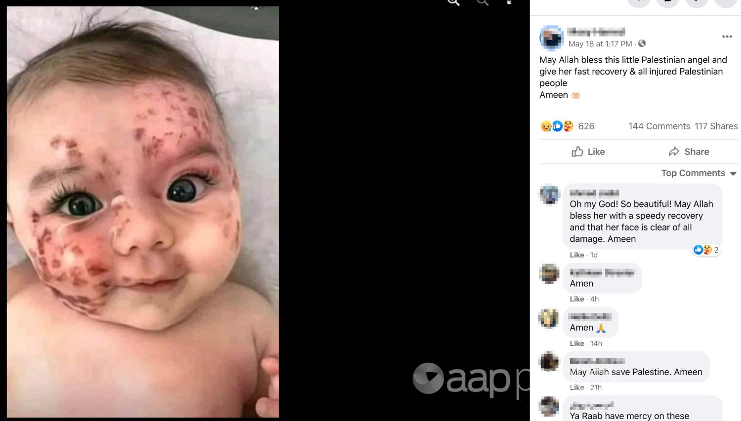 A Facebook post with an image of a baby with red marks on its face