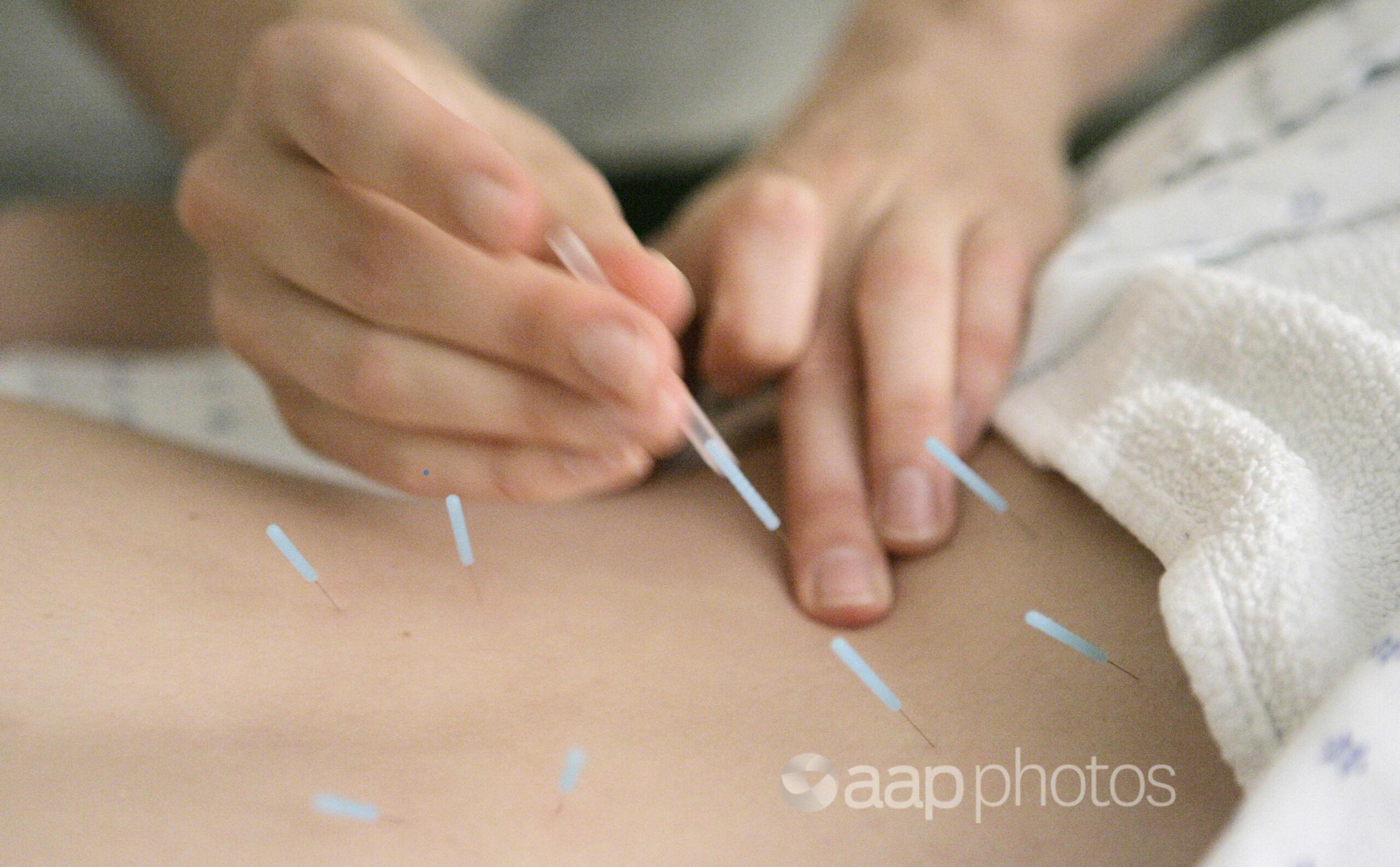 Acupuncture needles in the muscles near the spine to relieve back pain