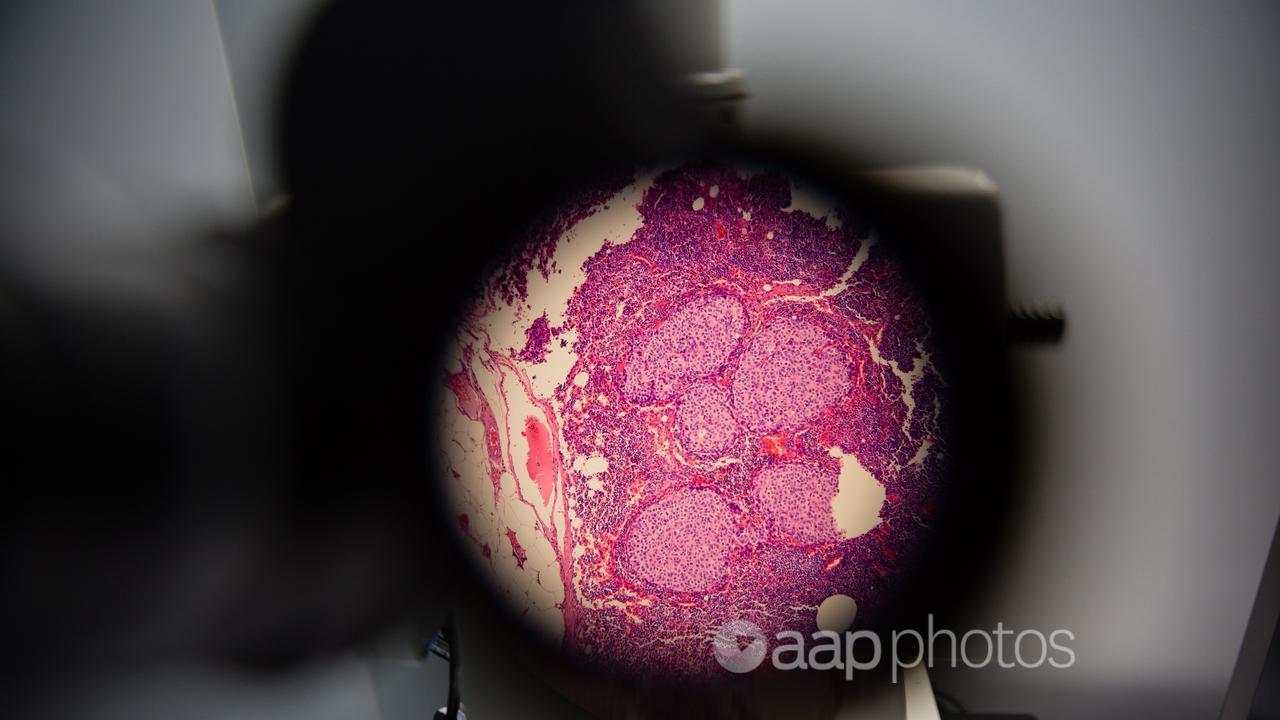 cancer cells seen through an augmented reality microscope