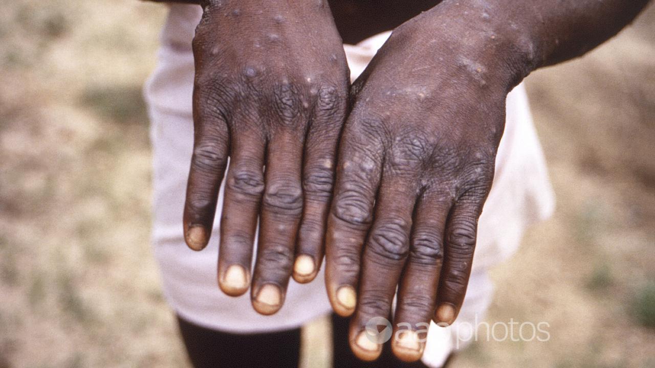 The hands of a monkeypox case patient (file image)