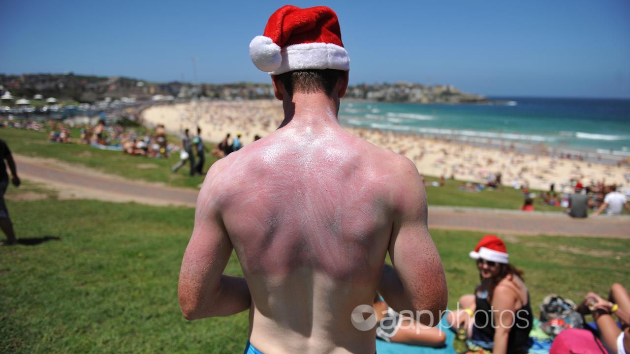 A man at the beach with sunburnt back.