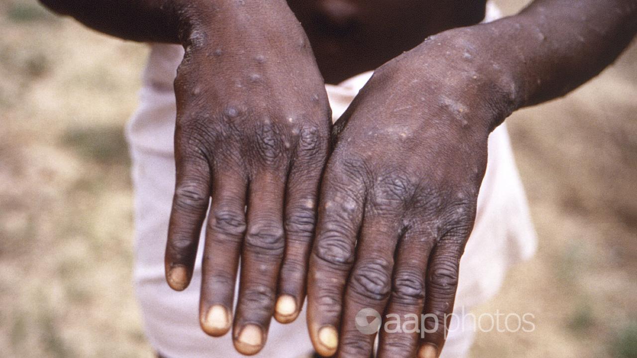 A man with mpox holds up his hands